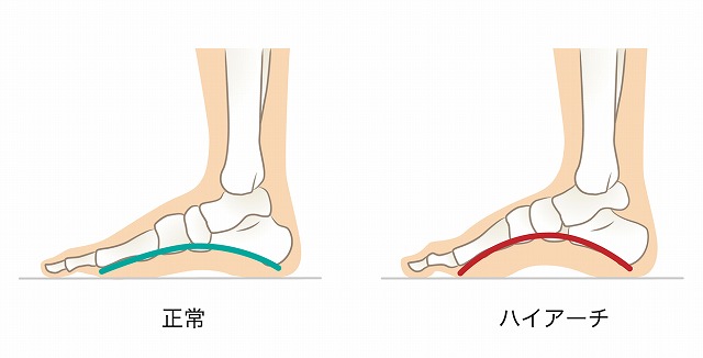 ハイアーチ（凹足：おうそく）