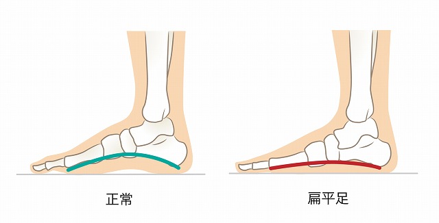 扁平足・開帳足