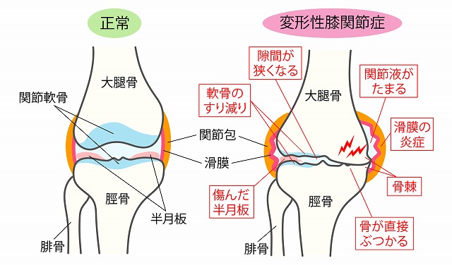 変形性膝関節症について