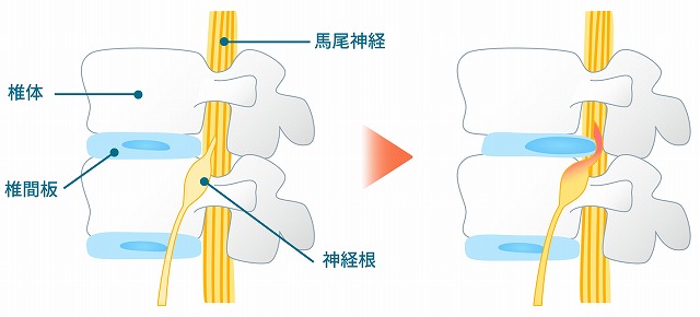 椎間板ヘルニアとは