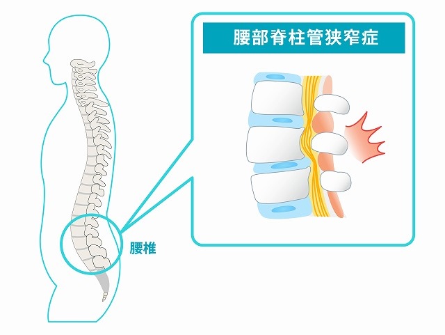 腰部脊柱管狭窄症